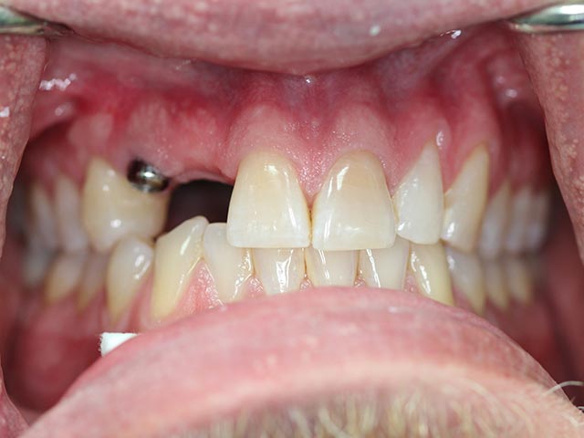 Implant before