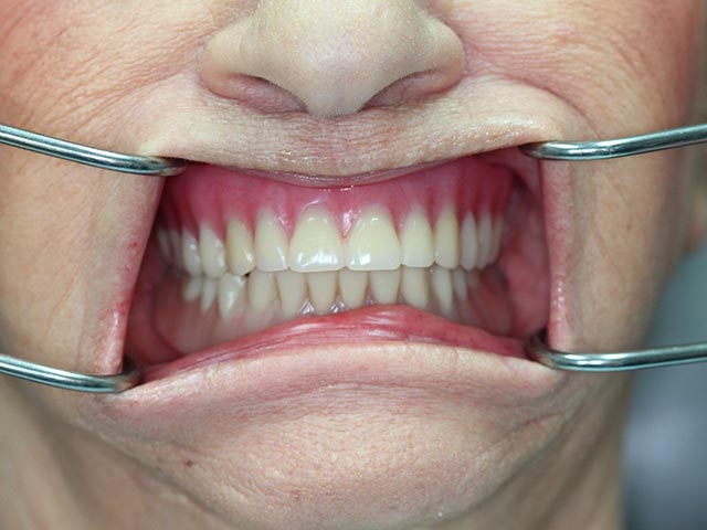 Implant Assisted Overdenture after