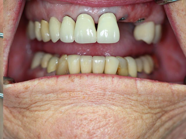 Immediate Implant Placement & Restoration before