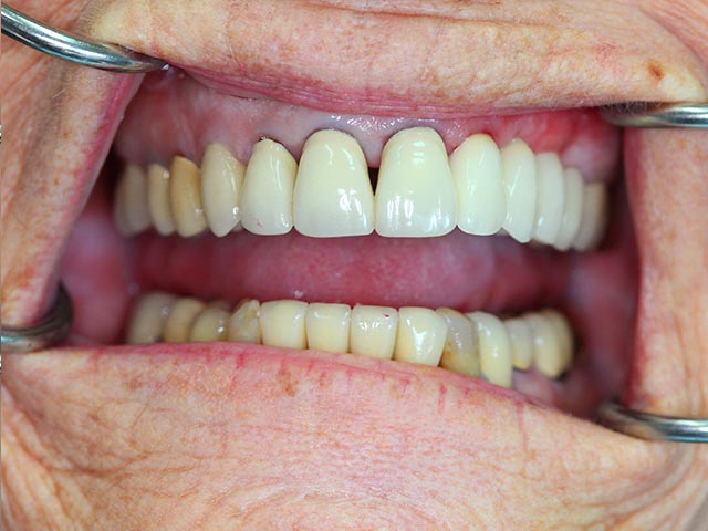 Immediate Implant Placement & Restoration after