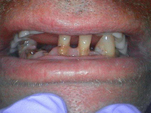 Implant Assisted Overdenture before
