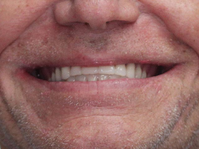 Implant Assisted Overdenture after